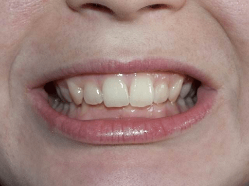 Глубокий прикус